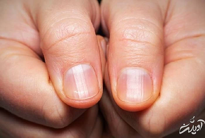 قرمزی ناخن از علائم دیابت قرمزی ناخن